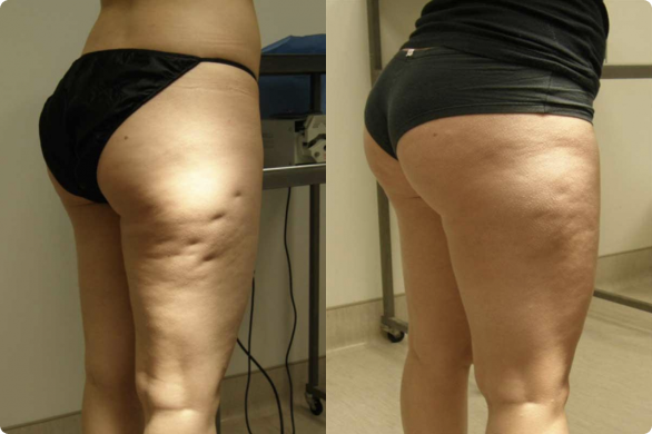Anti-Cellulite Therapy Massager